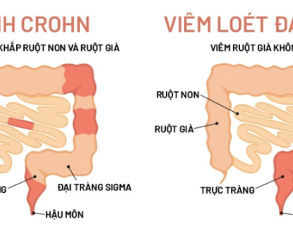 Phân biệt IBS với viêm đại tràng hoặc bệnh Crohn